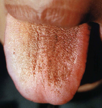 língua purpura